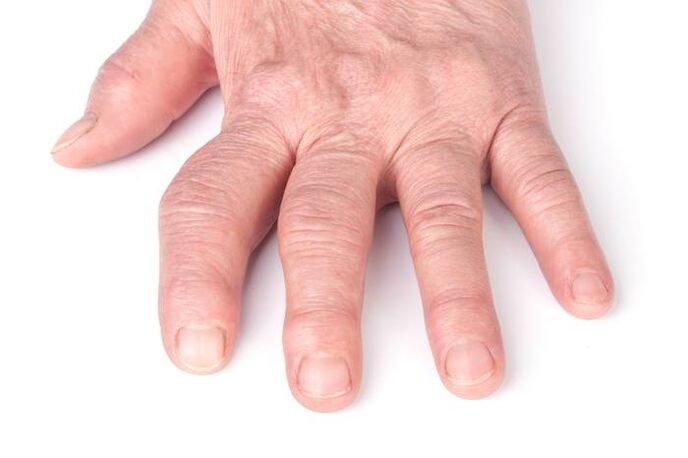 deformeeriv artroos kätel