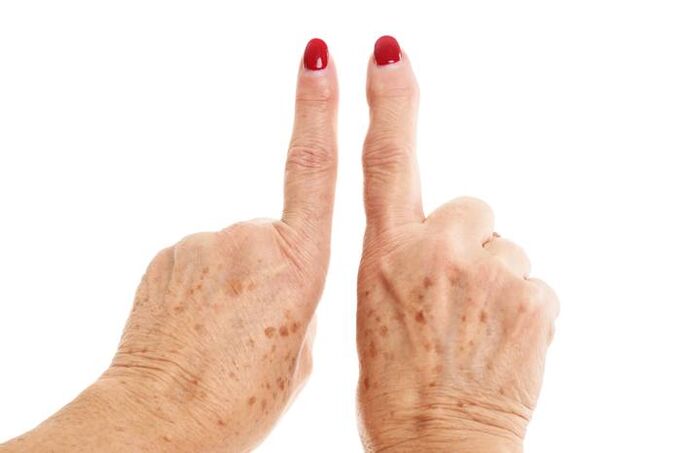 deformeeriv artroos sõrmedel