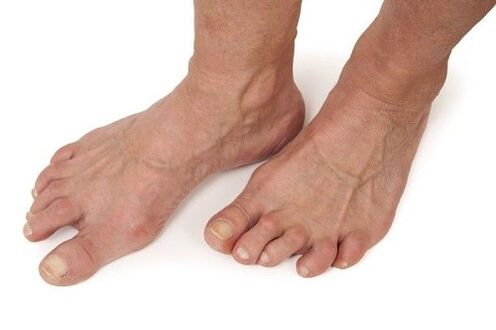 artroosist kahjustatud jalad