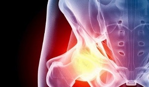 puusaliigese artroosi arengu põhjused