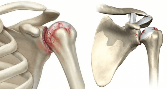 kuidas õlaliigese artroos välja näeb