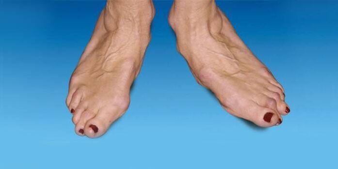 jala deformatsioon hüppeliigese artroosiga
