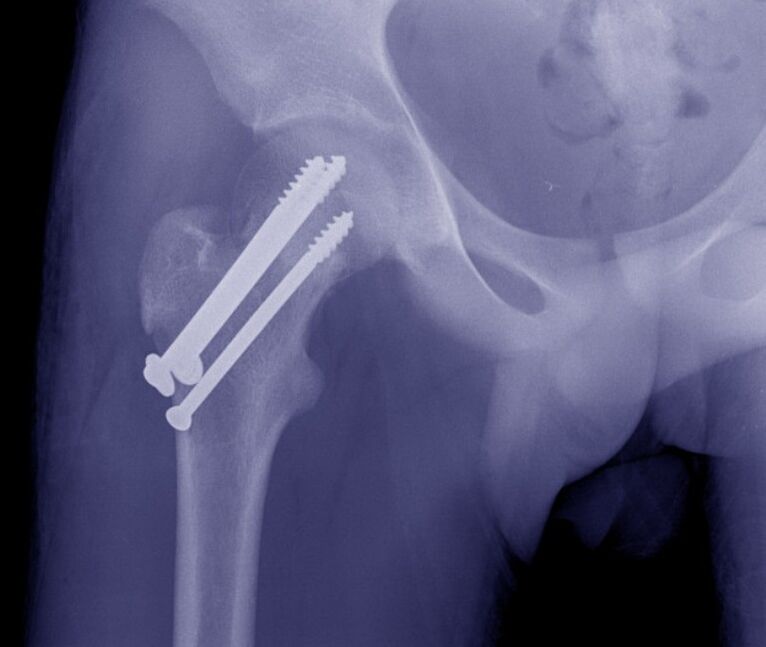 Puusaliigese röntgen, luumurru osteosüntees sisemiste fikseerimisseadmetega